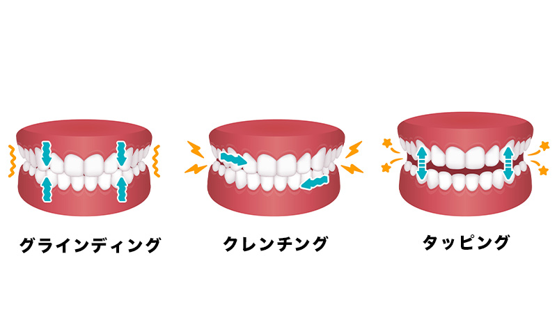 歯ぎしりの主な種類