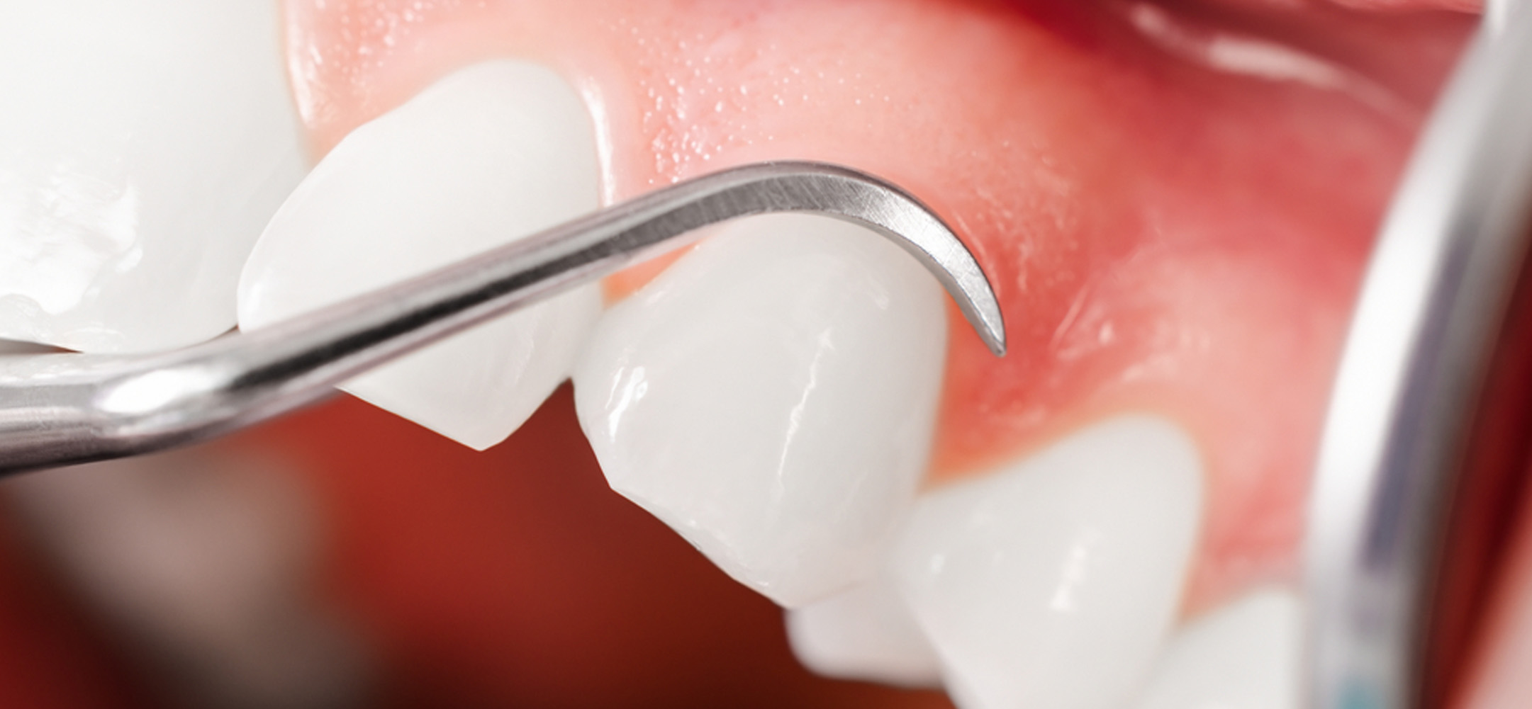 当院の歯周病の治療について