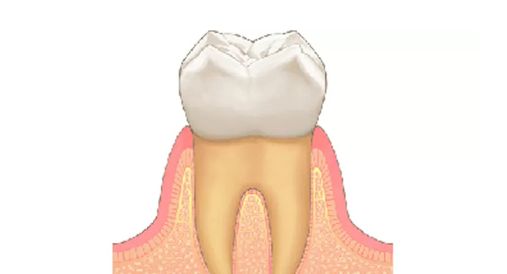 歯肉炎（歯周ポケットの深さ1〜2mm）